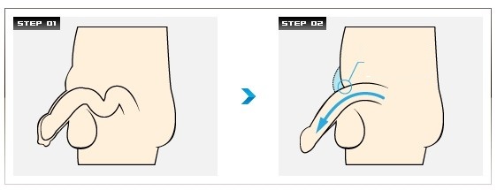 陰莖延長(zhǎng)手術(shù)過(guò)程和原理