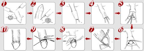 包皮手術過程